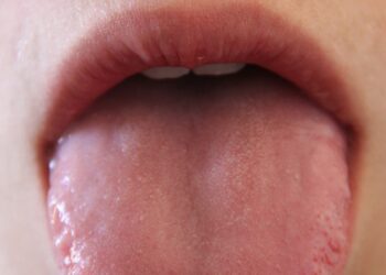 Glossitis: Process, Symptoms, Causes, and Types 