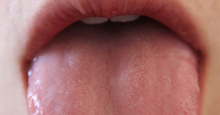 Glossitis: Process, Symptoms, Causes, and Types 