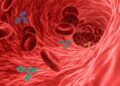 Aneurysm: Types, Symptoms and Causes