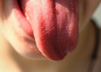 Black Hairy Tongue: Formation, Symptoms, and Causes 