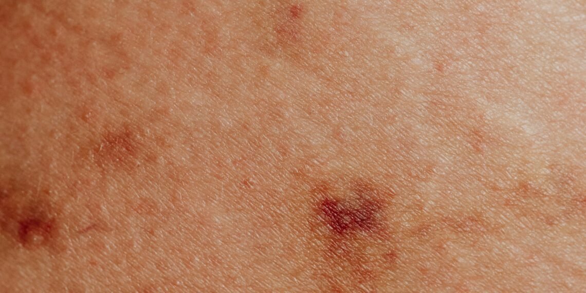 Heat Rashes in Nigeria: How to Stay Cool and Rash-Free in the Scorching Heat