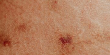 Heat Rashes in Nigeria: How to Stay Cool and Rash-Free in the Scorching Heat