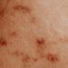 Heat Rashes in Nigeria: How to Stay Cool and Rash-Free in the Scorching Heat