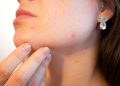 Mouth-Area Pimples: Why They Happen & How to Banish Them For Good