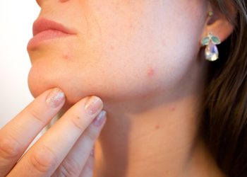 Mouth-Area Pimples: Why They Happen & How to Banish Them For Good 
