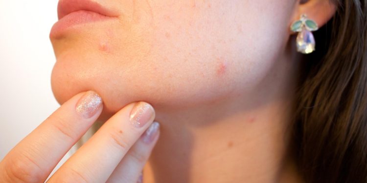 Mouth-Area Pimples: Why They Happen & How to Banish Them For Good