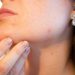 Mouth-Area Pimples: Why They Happen & How to Banish Them For Good