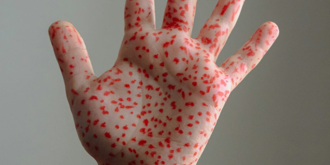 US Measles Deaths Rise as Local Officials Fill RFK Jr's Vaccine Void
