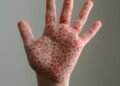 US Measles Deaths Rise as Local Officials Fill RFK Jr's Vaccine Void