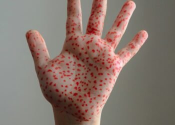 US Measles Deaths Rise as Local Officials Fill RFK Jr's Vaccine Void