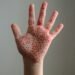 US Measles Deaths Rise as Local Officials Fill RFK Jr's Vaccine Void